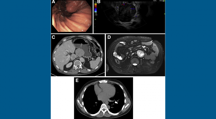 Multiple Tumors in a Young Patient