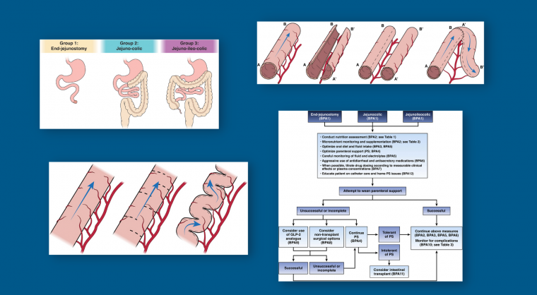 Collage of images from short bowel syndrome CPU