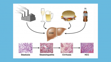 NAFLD Diagram