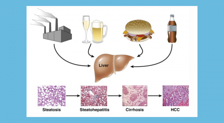 NAFLD Diagram