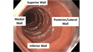 Nonampullay duodenal lesions