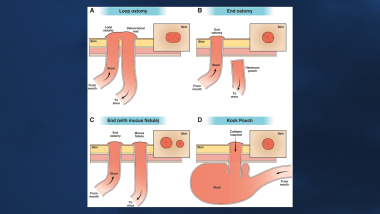 Figure 1. Different types of ostomy configurations.