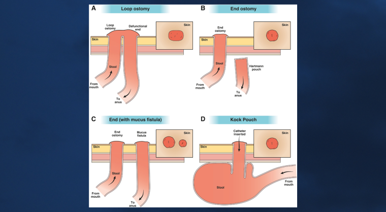 Figure 1. Different types of ostomy configurations.