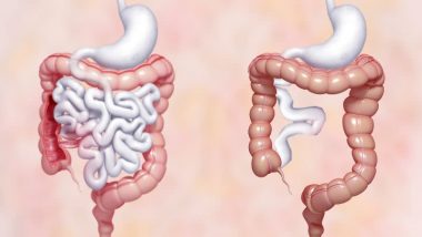 Optimize outcomes for patients with short bowel syndrome - American ...